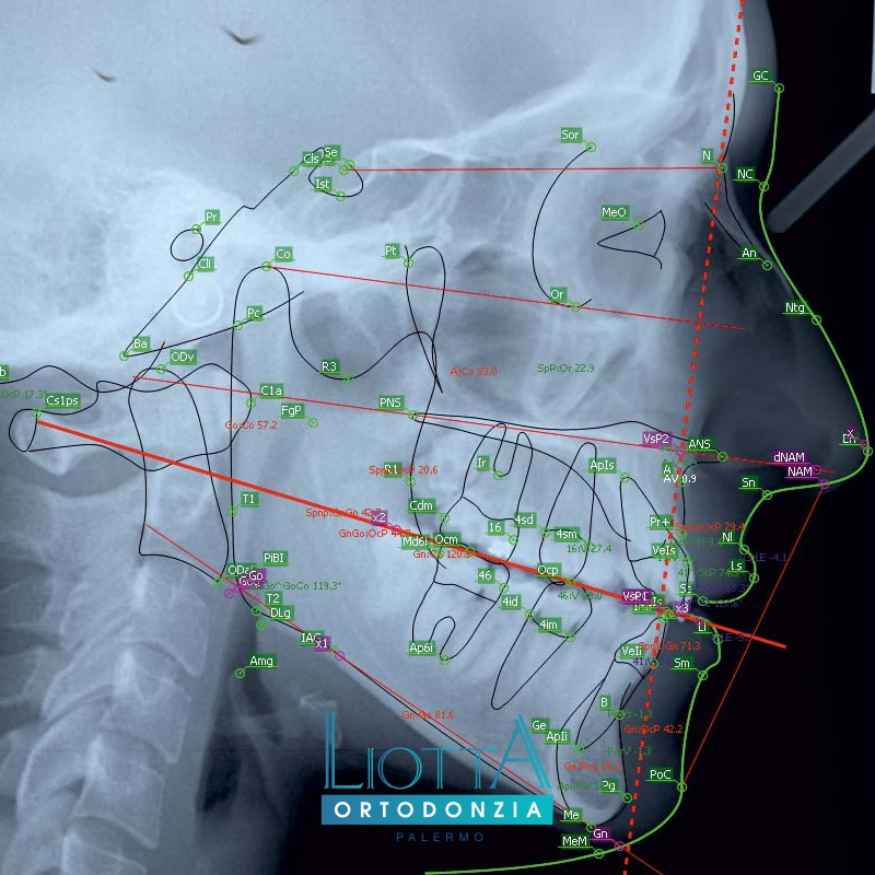 laboratorio ortodontico Liotta produce Cefalometrie
